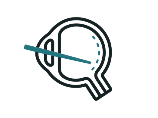 Tratamiento láser para glaucoma — Dr. Carlos Ortega