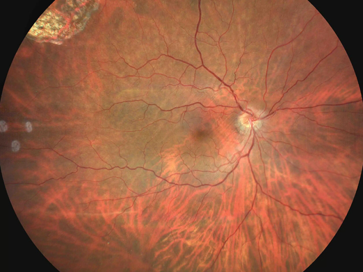 Estudios y procedimientos de retina